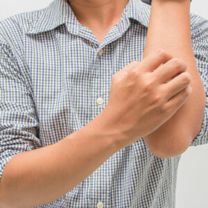 Eczema – Signs, Symptoms, and Home Remedies