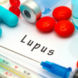 Lupus – Types and Warning Signs